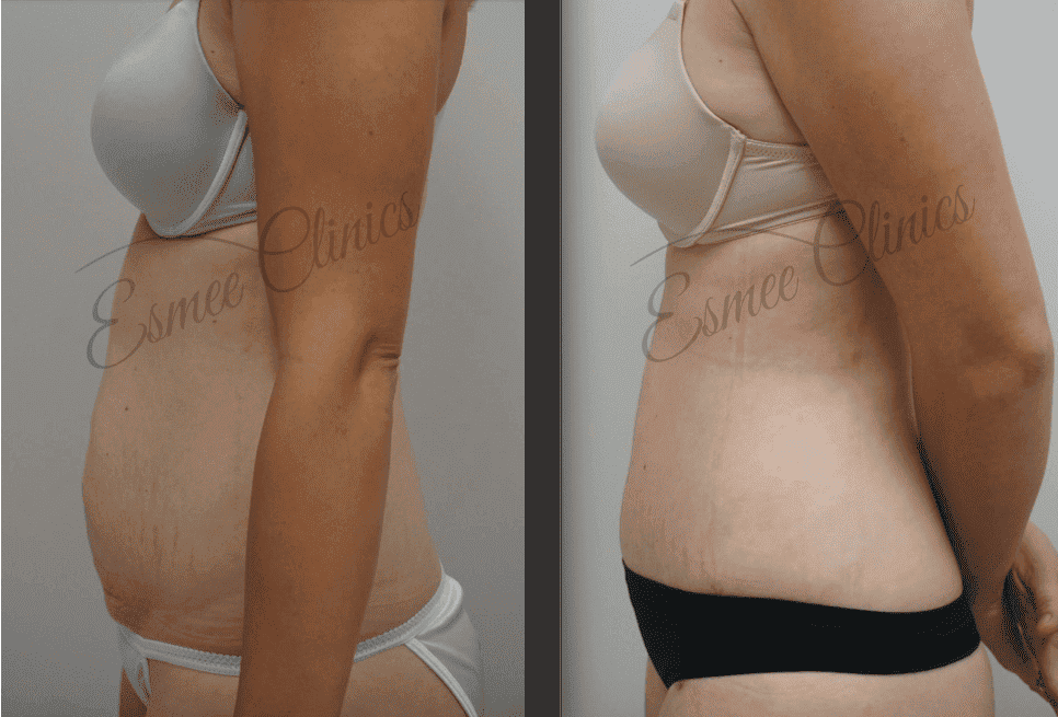 Before and After img